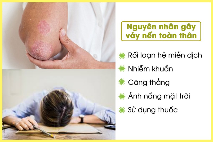 nguyên nhân vảy nến toàn thân