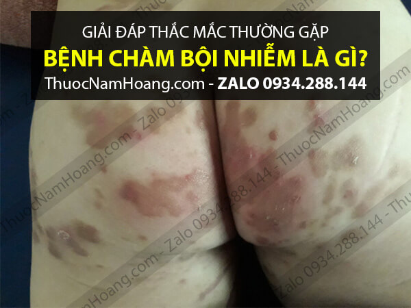 Chàm bội nhiễm có nguy hiểm không