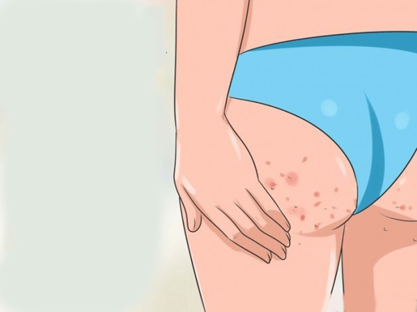bị ghẻ ở mông