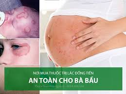 lác đồng tiền ở trẻ