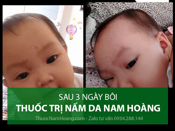 cách trị lác đồng tiền