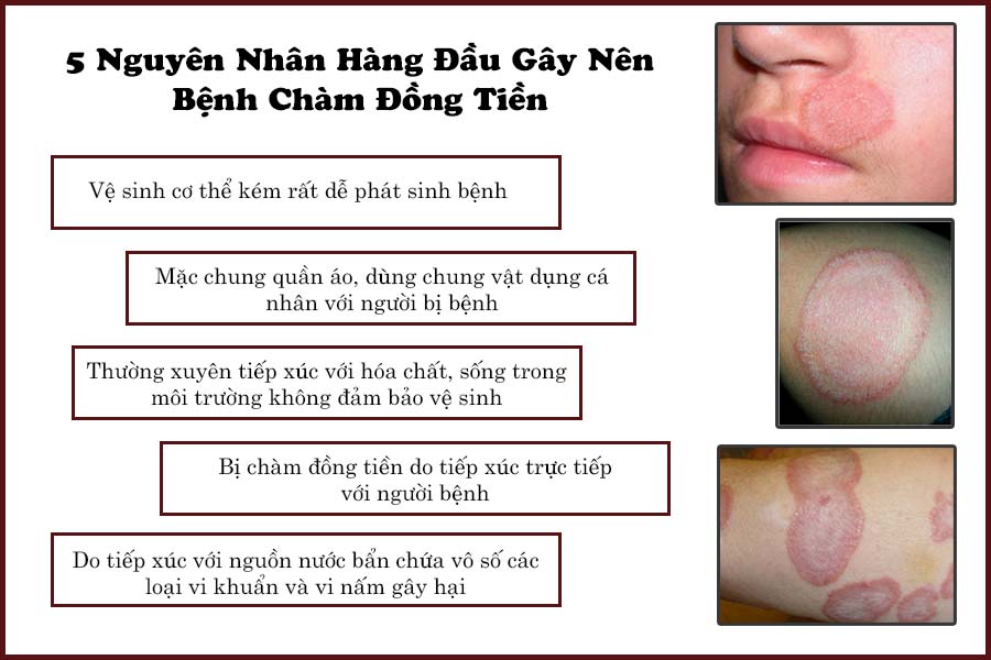 nguyên nhân chàm đồng tiền