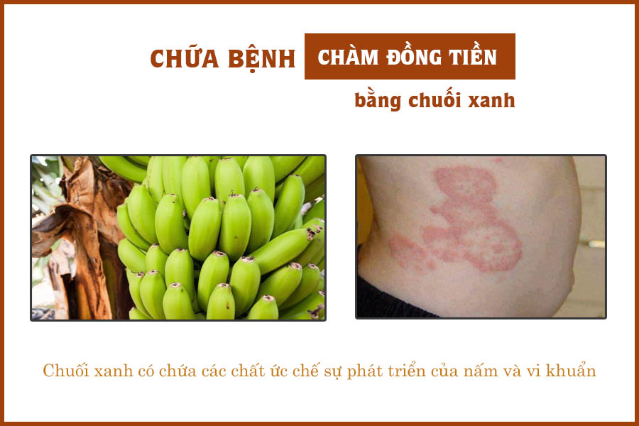 chuối xanh trị chàm đồng tiền