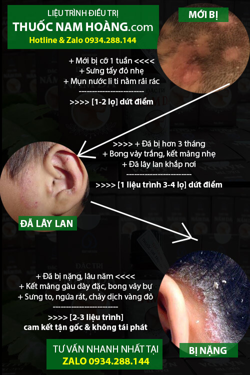 điều trị vảy nến da đầu
