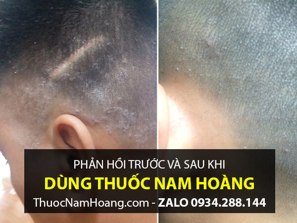 trước và sau khi trị vảy nến da đầu