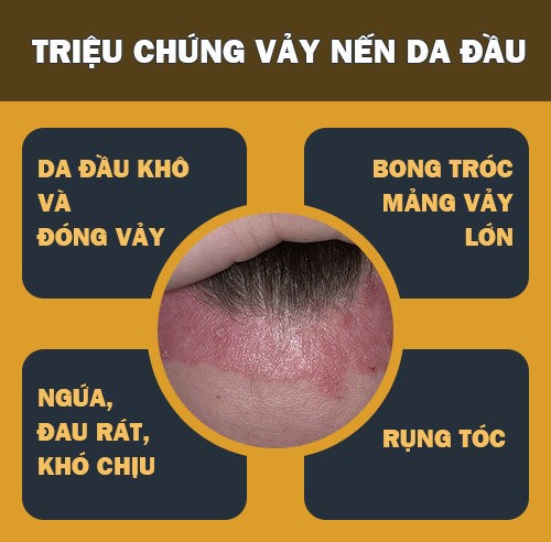 nguyên nhân da đầu bị bóc vảy trắng