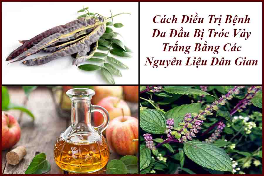 cách trị da đầu bị tróc vảy trắng