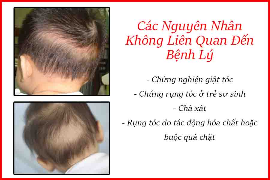 nguyên nhân bệnh rụng tóc ở trẻ em