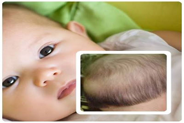 bệnh rụng tóc ở trẻ em