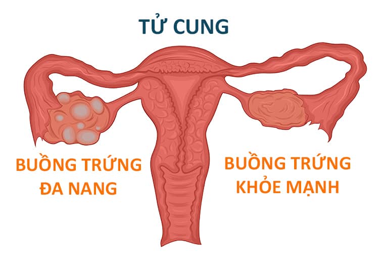rụng tóc nhiêu do đa nang buồng trứng