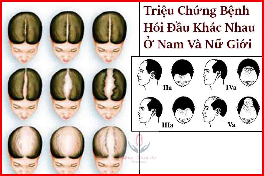 dấu hiệu hối đầu ở nam và nữ