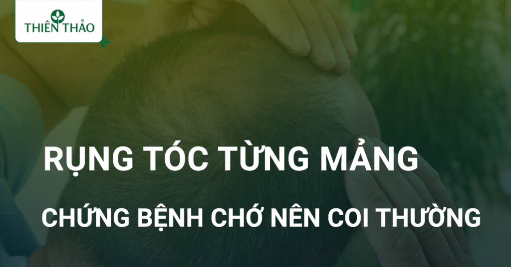 rụng tóc từng mảng có nguy hiểm không