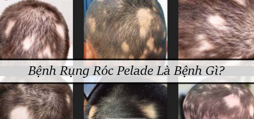 rụng tóc plelade là bị gì