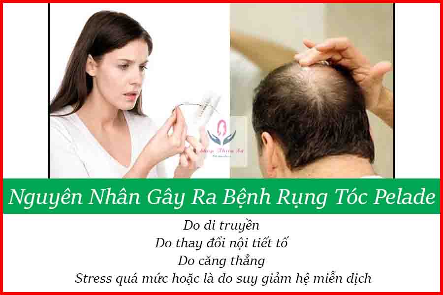 Nguyên nhân gây ra căn bệnh rụng tóc Pelade