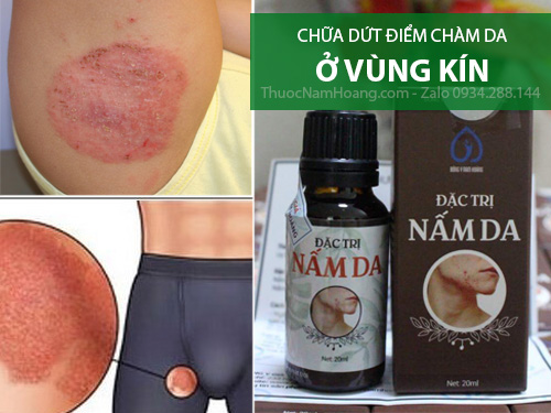 thuốc chữa chàm bìu