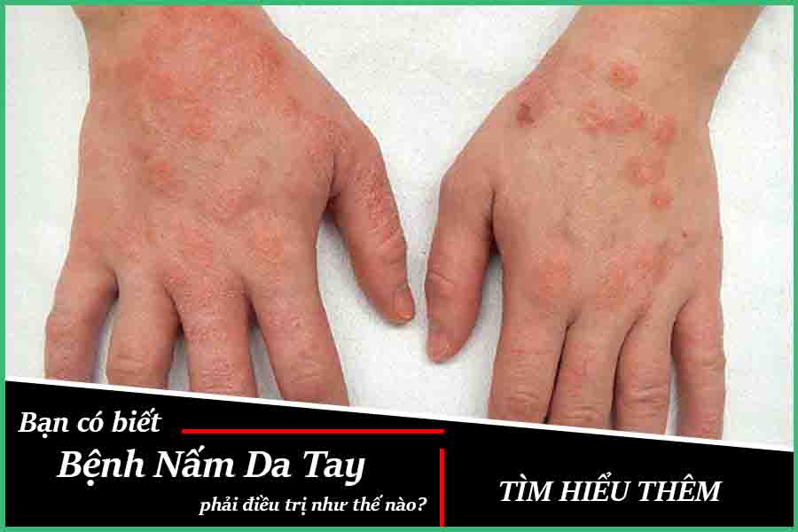 bệnh nấm da tay
