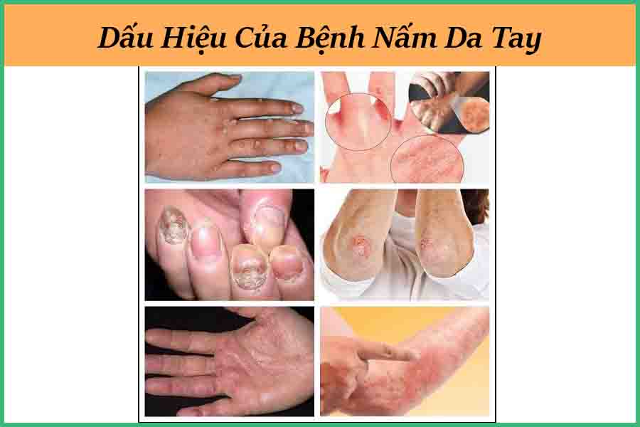 dấu hiệu nấm da tay