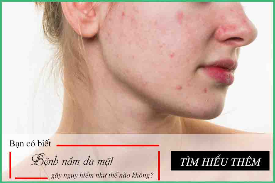 nấm da mặt