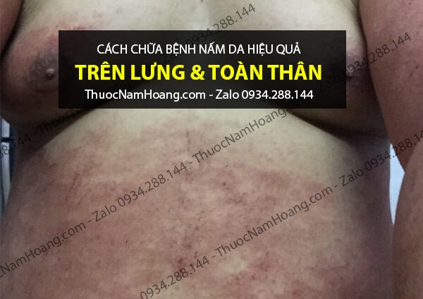 nấm da ở lưng và toàn thân