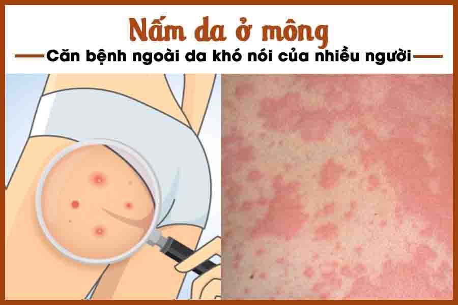 nấm da mông