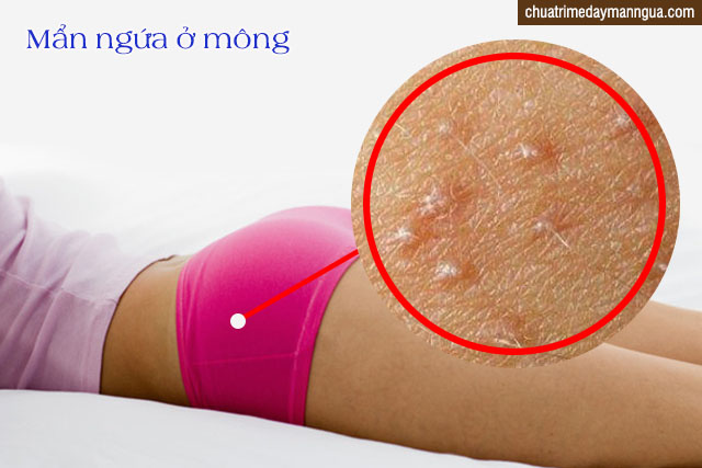 nấm da ở mông có lây không