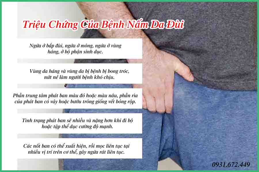 dấu hiệu nấm da đùi