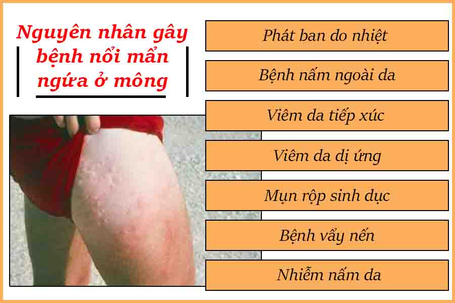 nguyên nâhn bị mẫn ngứa ở mông