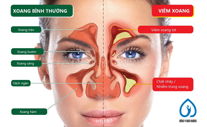Thuốc gia truyền chữa viêm xoang