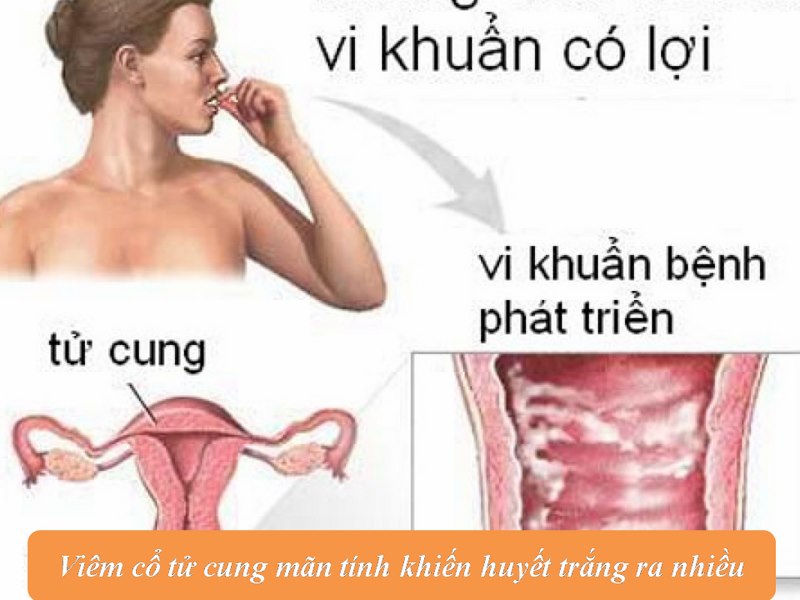 huyết trắng có bọt ở tử cung