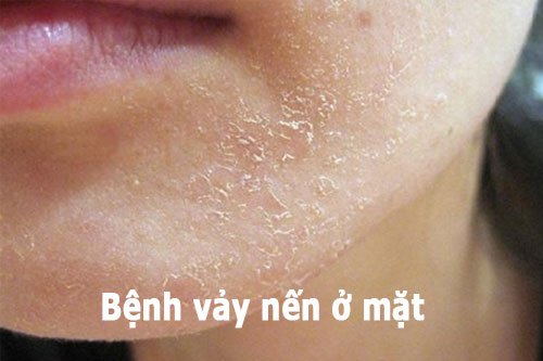 vảy nến da mặt