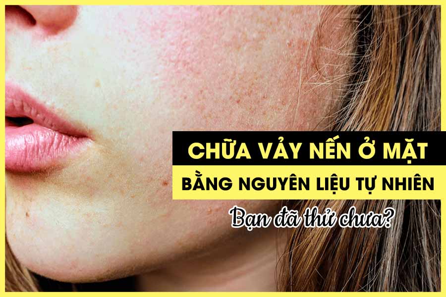 nguyên nhân vảy nến da mặt