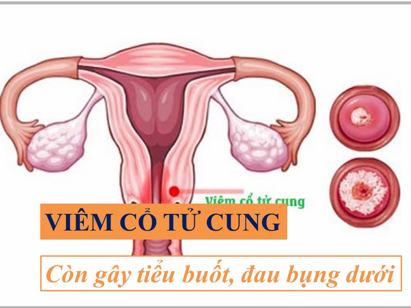 Viêm cổ tử cung dẩn đến ngứa cửa mình