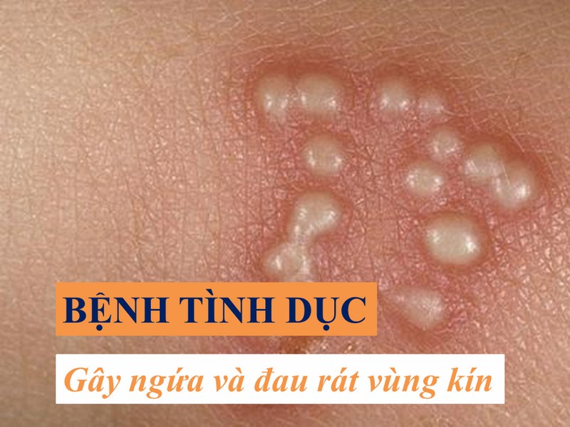 Cửa mình ngứa do bệnh lây truyền