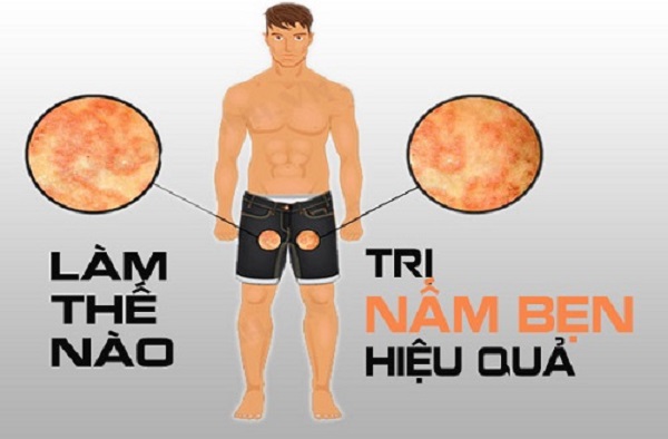 nấm bẹn nguyên nhân gì