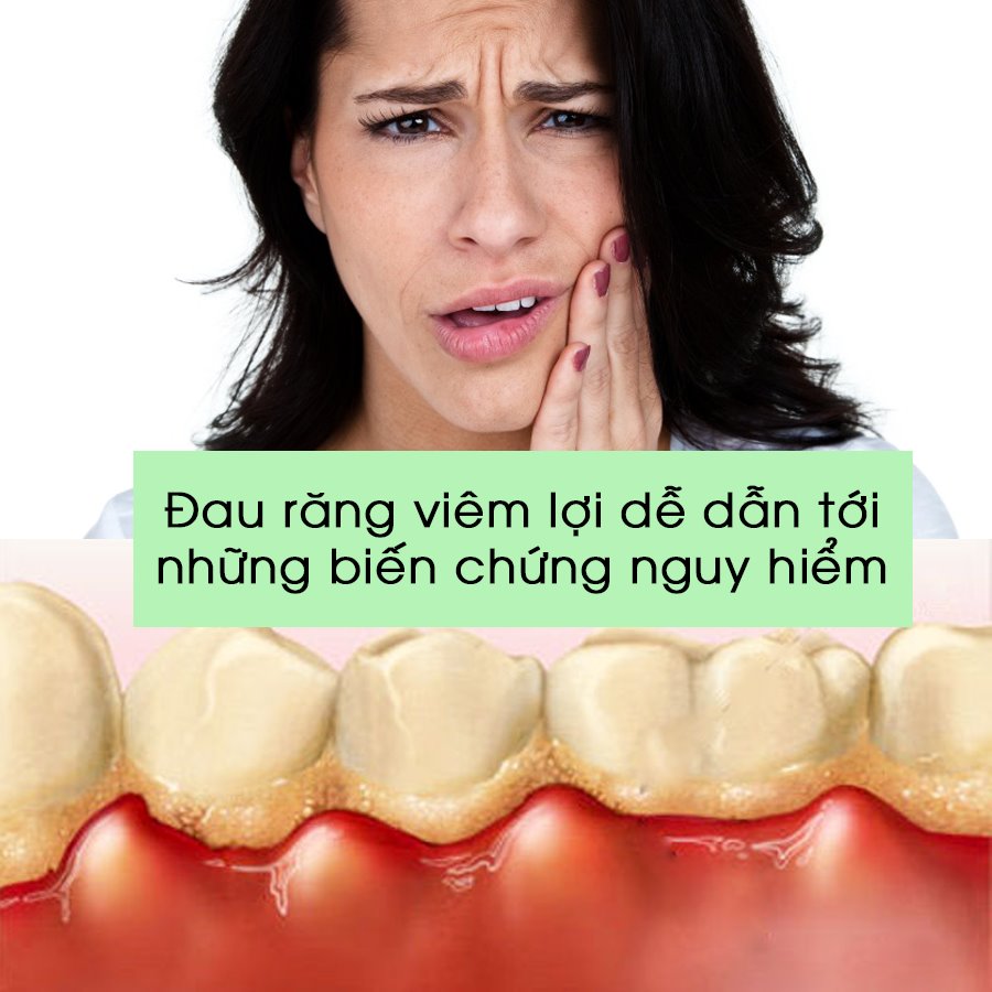 Viêm nướu răng
