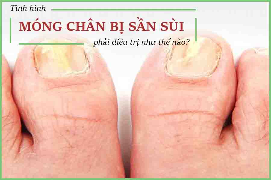 móng chân bị sần sùi