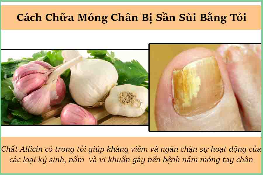 chữa móng chân sần sùi bằng tỏi