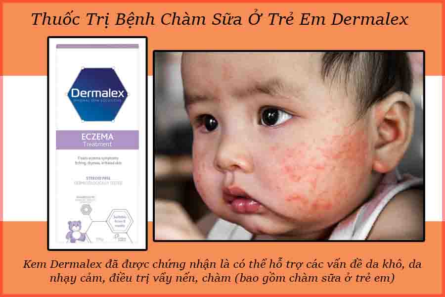 Thuốc Dermalex chữa trị bệnh chàm háng ở trẻ em