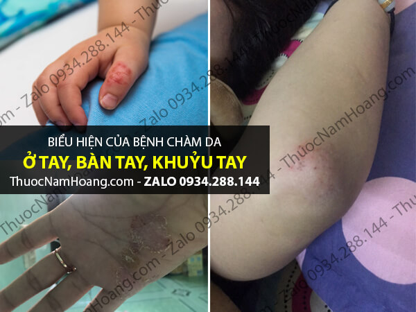 dấu hiệu của chàm đầu chi