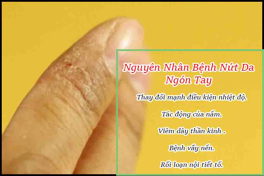 nguyên nhân bệnh nứt da đầu ngón tay