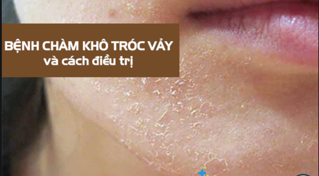 chàm khô tróc vảy