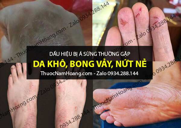 dấu hiệu bà bầu bị á sừng