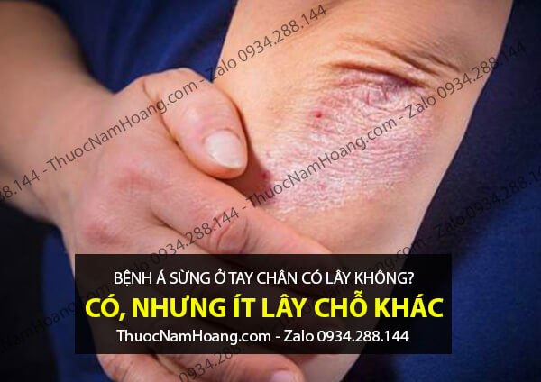 bệnh á sừng ở tay có lây không