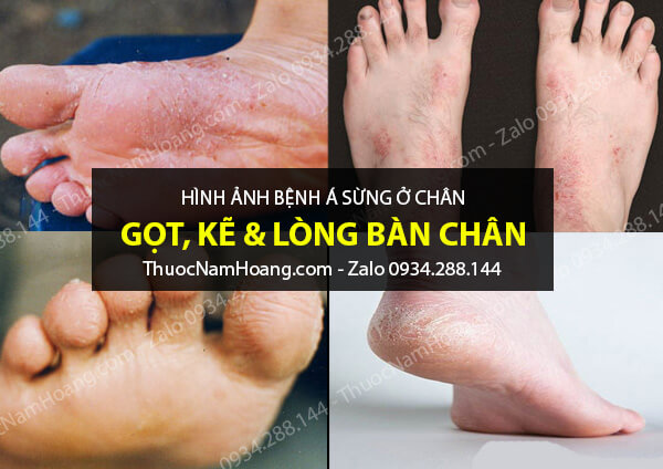 hình ảnh bệnh á sừng ở chân