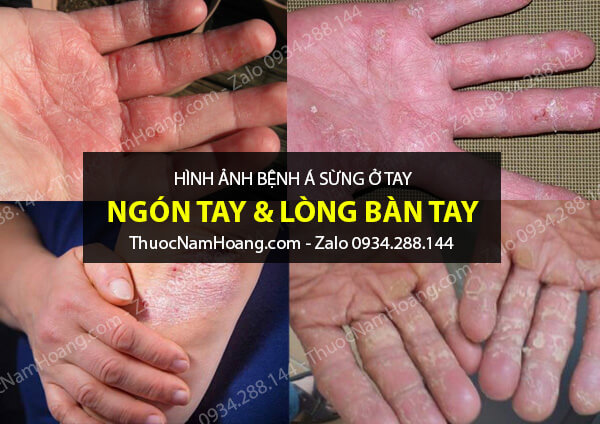 hình ảnh bệnh á sừng ở tay