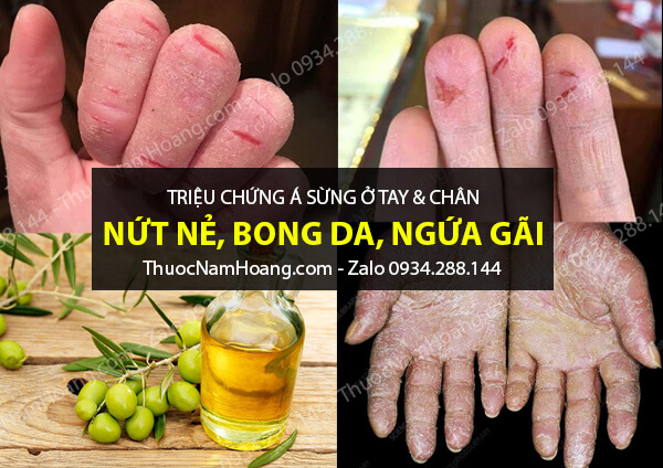 triệu chứng á sừng ở tay chân