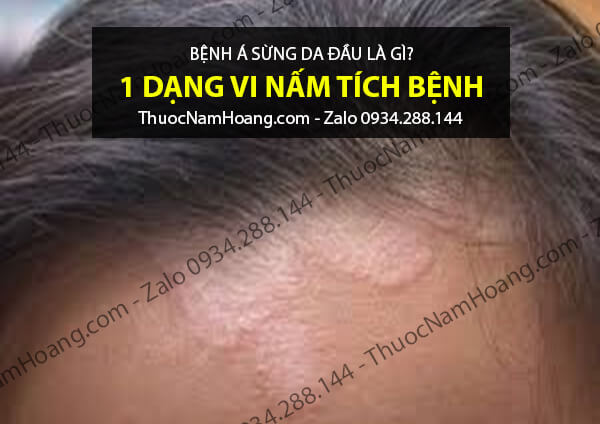 thuốc điều trị bệnh á sừng da đầu