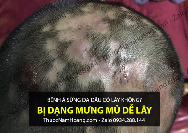 bệnh á sừng da đầu có lây không