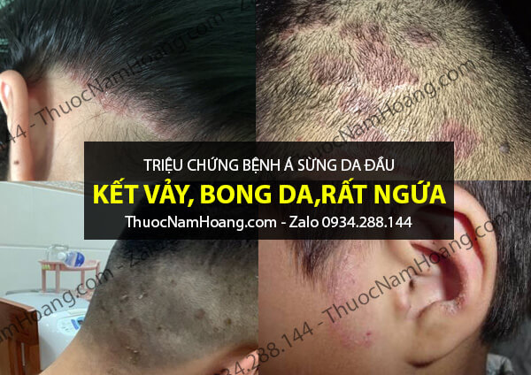 triệu chứng bệnh á sừng da đầu
