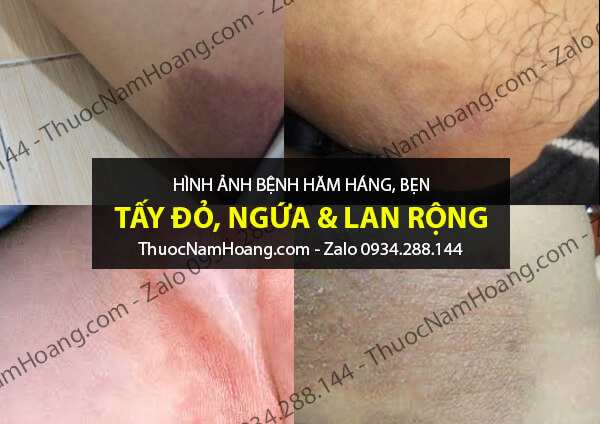 hình ảnh bị hăm háng ở nam